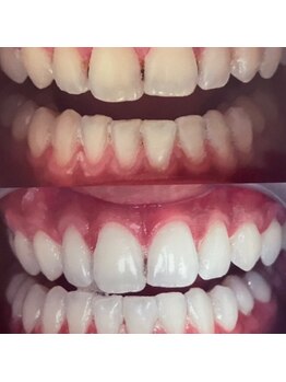 シャイニー 掛川店(shiny)/30代　７回【ホワイトニング】