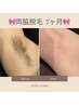 脱毛デビューに◎【黒ずみ＆毛穴の改善予防◎】両脇脱毛 2回￥7920→¥3300