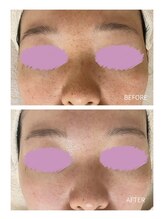 エモベーシック(e'MO BASIC)/BBLと漢方ハーブ