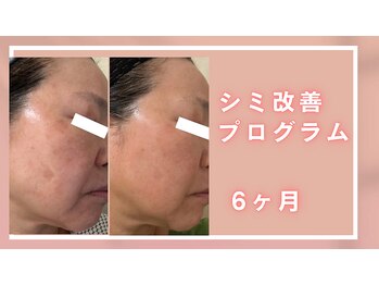 シャルナ(charna)/オンラインシミ肌改善