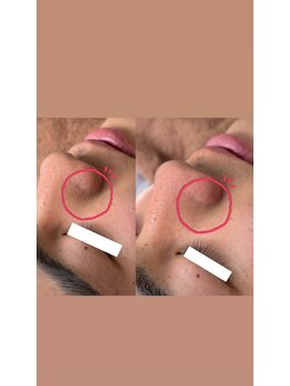 リートライ(Re Try)/ハーブピーリング