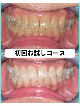 ホワイトニングビューティー 吉祥寺店/ホワイトニング 初来店