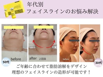 クリニカルエステ イーズ あべのキューズタウン店の写真/【フェイシャル】レモンボトル×ヒト幹細胞コース¥16500→¥8800★気になるところにダイレクト注入♪小顔!