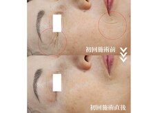 ソイ(Soi)/シワが1回施術でこんなに薄く！