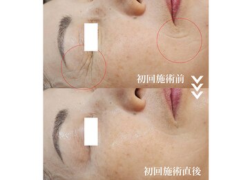 ソイ(Soi)/シワが1回施術でこんなに薄く！