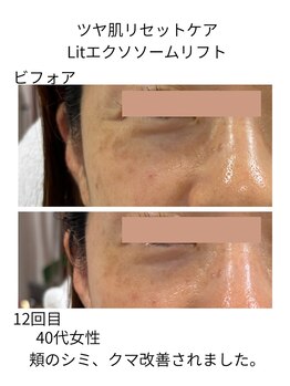 フラワー(FLOWER)/40代女性 ツヤ肌+Lit12回