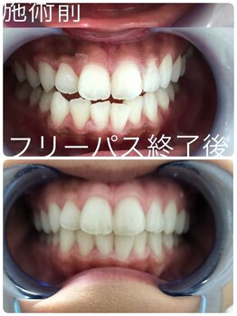 ストーン 飯田店(Stone)の写真/初めてのホワイトニングに、3回4,980円で始めやすい◎お得なフリーパスもご用意。