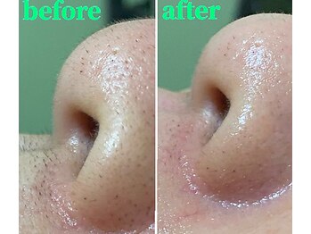 ナチュウル(Natulu)/シルク糸脱毛＊産毛で黒ずむ鼻に