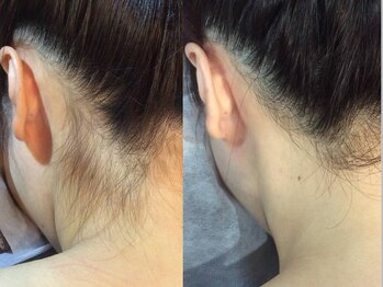 脱毛サロン ベル(Bell)/【レディース脱毛】