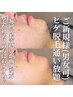【3名限定】ヒゲ脱毛通い放題/脱毛初心者の方にオススメ♪/最大5回/男女OK◎