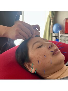 鍼灸マッサージ院 アカシアの写真/【国家資格保持】鍼灸の効果を体感したことはありますか？肩こりや腰痛にも◎美容鍼は男女問わず人気です♪