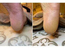 ココン フワット(cocon fouato)/角質before・after銀座/日本橋