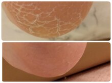 フットケアサロン ラビフット(Rabbi foot)/乾燥踵はすぐに柔らかく