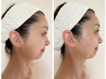 ル シエル(Le Ciel)/40代/施術横顔/左before右after