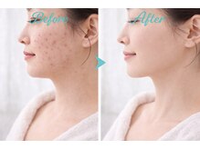 アプロ(Aphro)/ニキビここまで改善