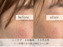 モラン(MO.RAN)/シミケア4回施術でシミが小さく