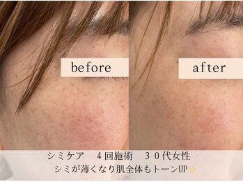 モラン(MO.RAN)/シミケア4回施術でシミが小さく