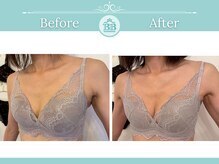 ベルビューティー(belle beauty)/【胸のたるみ・垂れ乳改善】症例