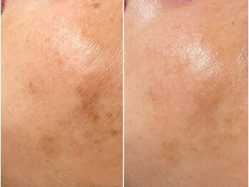 ラエッセ 恵比寿(LAESSE)/毛穴・美白専門店 LAESSE 恵比寿