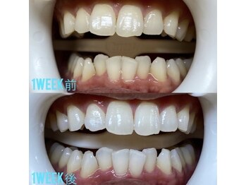 ホワイトニングセンター 大阪京橋店/BeforeAfter