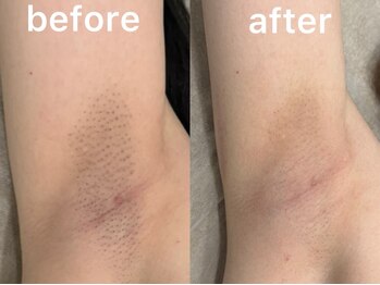 ウィステリア(WISTERIA)/ワキ脱毛