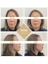 ただき接骨院 整体院 高崎本院/深層リフトケア美容鍼