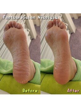 ニコルル 大阪天満店(Nicolulu)/ひび割れのない［カカト］へ