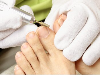 アトリエ整骨院/痛みから解放する巻き爪補正1つ