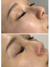 ラグ(LUXU)/肌育ピーリング