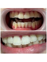 ワイズサロン(Y's salon)/ホワイトニング5回の症例写真