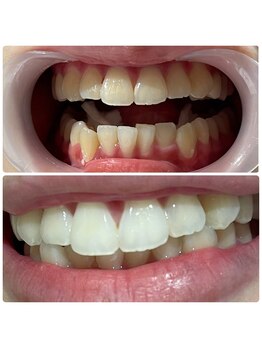 ワイズサロン(Y's salon)/ホワイトニング5回の症例写真