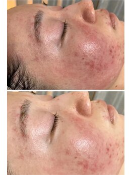 マリエンドリー/赤み/ニキビ改善◎