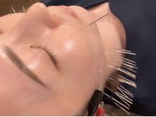 オリエンタル ルボワール(oriental Revoir)/顔鍼100本　美顔鍼　美容鍼灸