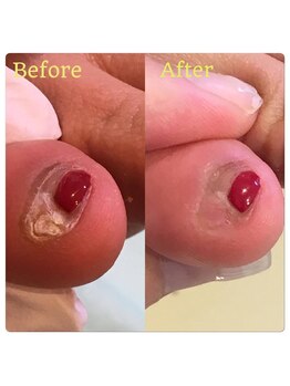 巻き爪補正店 越谷店/