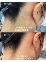 サロンドベルム(Salon de BELME)/ダブル脱毛：before/after