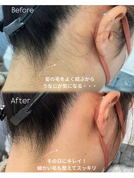 サロンドベルム(Salon de BELME)/ダブル脱毛：before/after