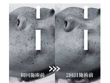 ソイ(Soi)/たった1回でもこの変化！