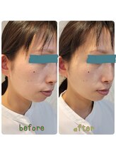 ピエール ナリタイラボ(Piel NARITAI LABO)/小顔整体