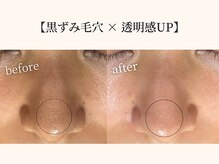 ドリームスパ 武蔵小杉店(DREAM SPA)/毛穴吸引＋引き締めパック＋導入