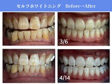 エクシアホワイトニング 岡崎店/歯の黄ばみ撃退★白さ満足度No.1