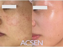 リトルーム(Litroom: from Seoul)/敏感肌さん用の専門的エステ