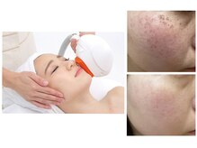 素肌美人の雰囲気（フォト×ラジオ波で様々な肌悩みに対応！おシミ・たるみ改善♪）