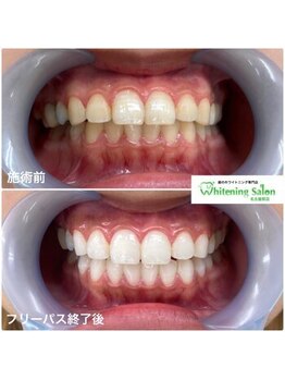 ホワイトニングサロン 名古屋駅店/【ホワイトニング施術例】
