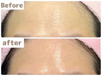 ヒール(heal)/症例