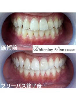 ホワイトニングサロン 京都烏丸店/ホワイトニング施術例