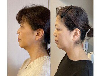 小顔22 ボルティ 赤坂支店(Bolty)/【悩み】50代：老け顔