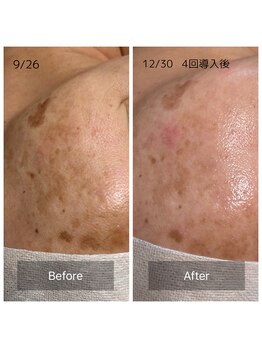 アンド リュクス(& Luxe)/美肌ケア