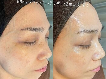 エヌエースキン 川崎店(NAskin)/ハーブピーリング｜シミしわケア