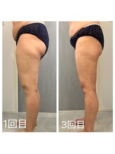 美温(mion)/ヒップアップ　3回目