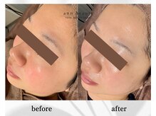 アン ビューティー(ann beauty)/【症例写真】30代女性